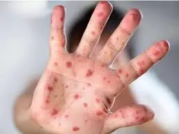 Exames descartam mpox em paciente atendido em Mossoró